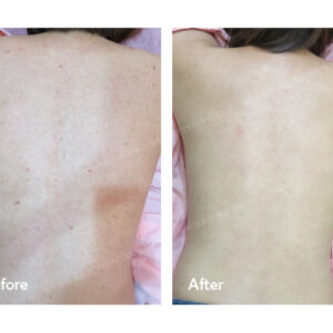 Guo Discovery Pico Mandelic acid ANYYOUNG